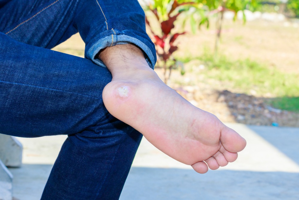 Plantar warts: causes, symptoms and treatment