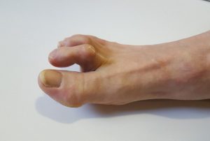 Image de :Hammer toe : symptoms and treatments