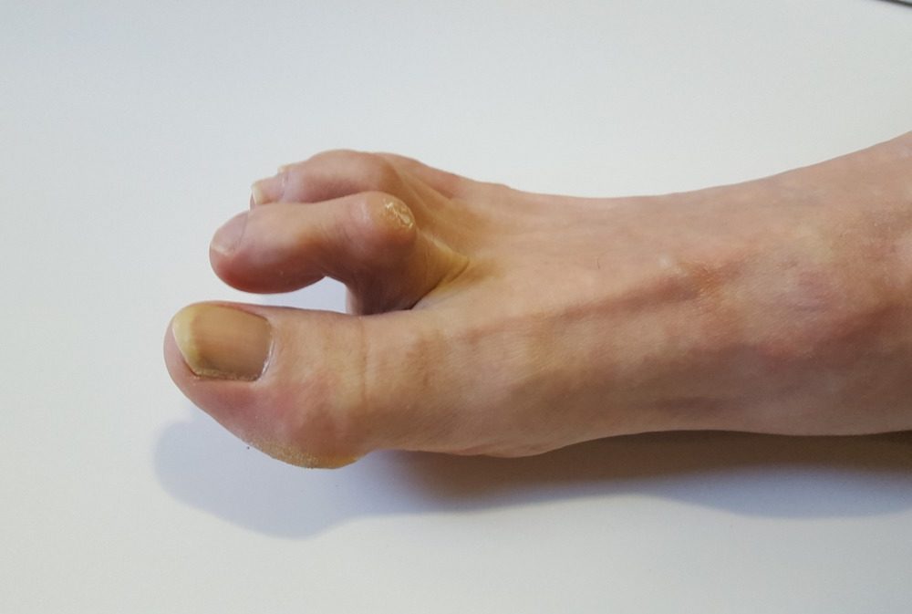 Quels sont les différents types de pieds?