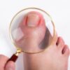 Ingrown toenail (onychocryptosis)