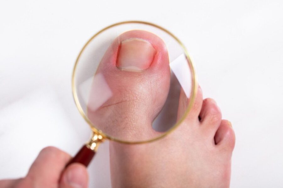 Image de :Ingrown toenail (onychocryptosis)