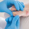 Nail fungus (Onychomycosis)