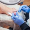 Ingrown toenail treatment by a podiatrist
