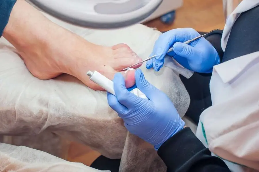 Image de :Ingrown toenail treatment by a podiatrist
