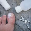 Surgery for an ingrown toenail (or matricectomy)