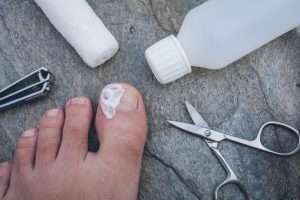 Image de :Surgery for an ingrown toenail (or matricectomy)