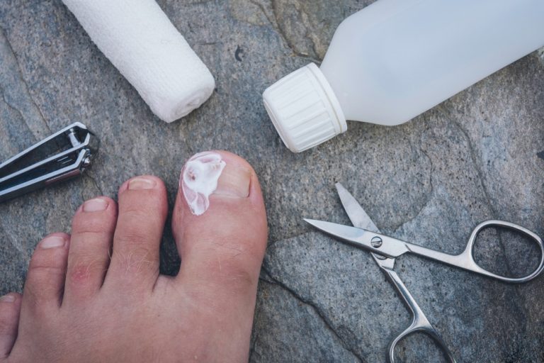 Surgery for an ingrown toenail (or matricectomy)