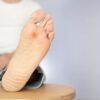 Recalcitrant plantar wart surgery