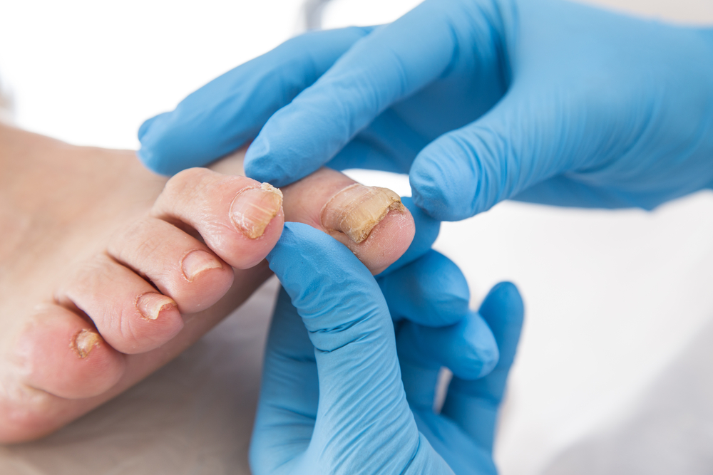 How can we prevent nail fungus infection?