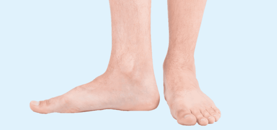 Image de :Flat foot or cavus foot: which one do you have?