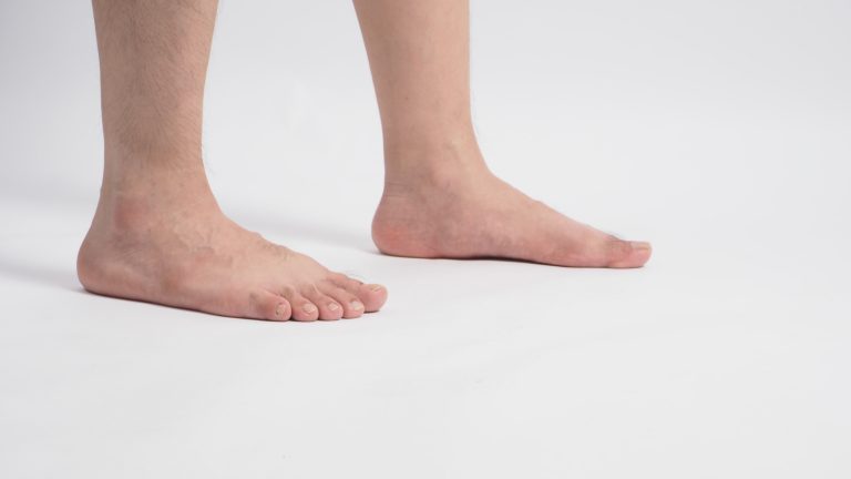 Image de :Flatfoot : symptoms and treatments