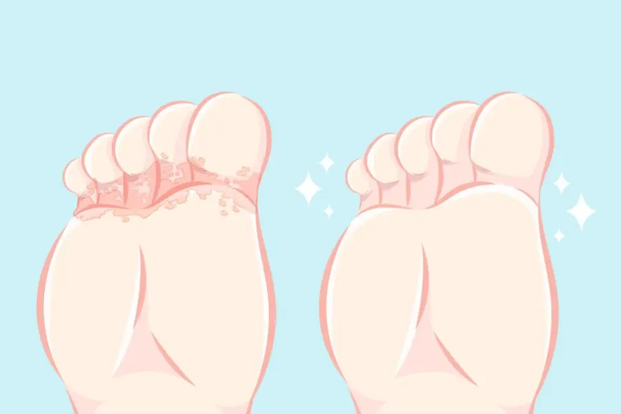 Athlete’s foot: everything you need to know about this infection