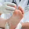 Athlete’s foot (tinea pedis)