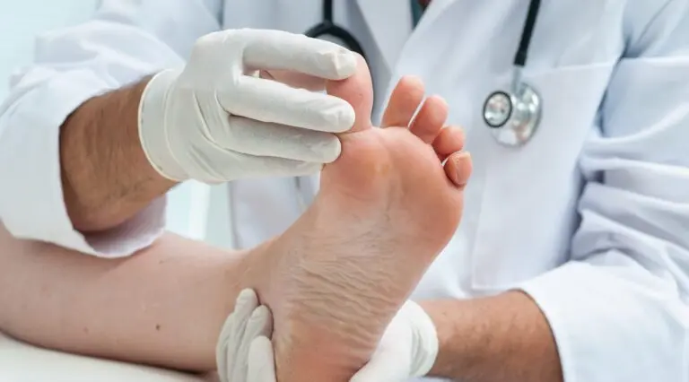 Athlete&#8217;s foot (tinea pedis)