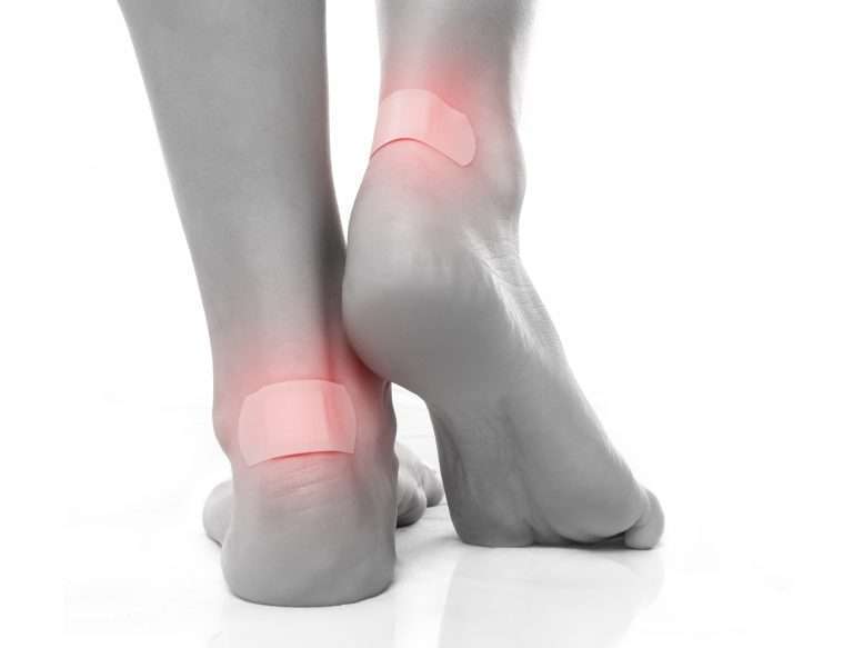 Image de :Foot blisters : symptoms and treatments