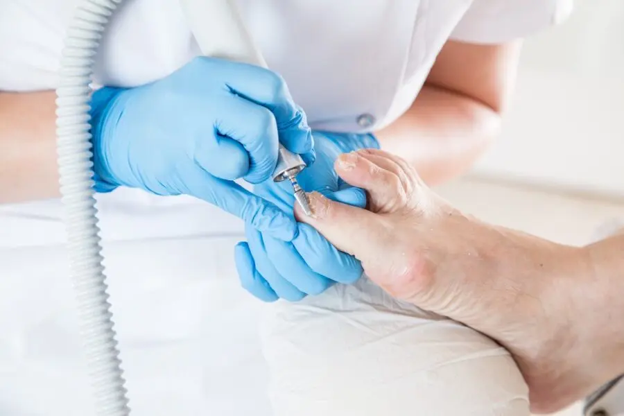 Image de :L’ongle traumatique : symptômes et traitements