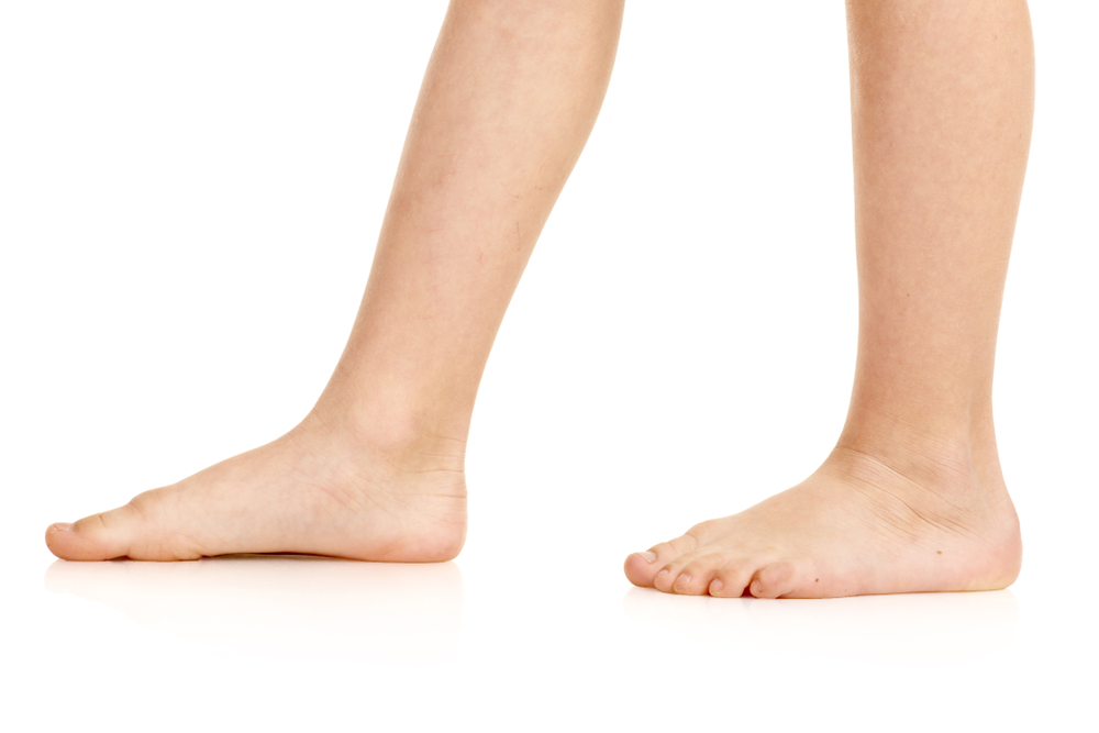 How can we identify flat foot in children?