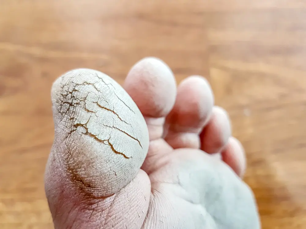 Les crevasses au pied | PiedRéseau