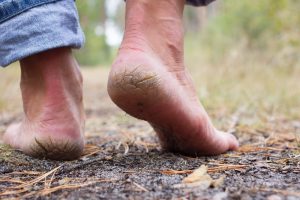 Image de :Heel cracks : symptoms and treatments