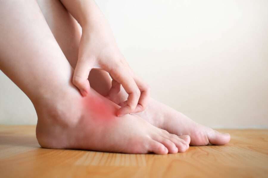 Image de :5 tips to relieve foot eczema