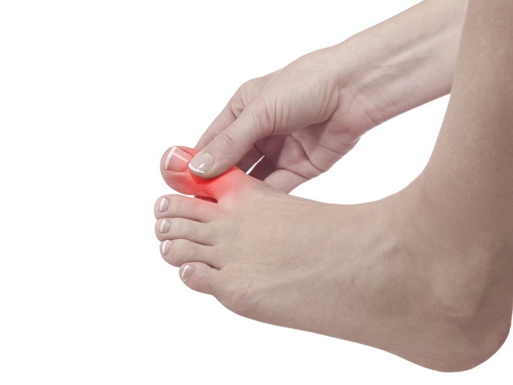 4 home remedies for gout in the foot