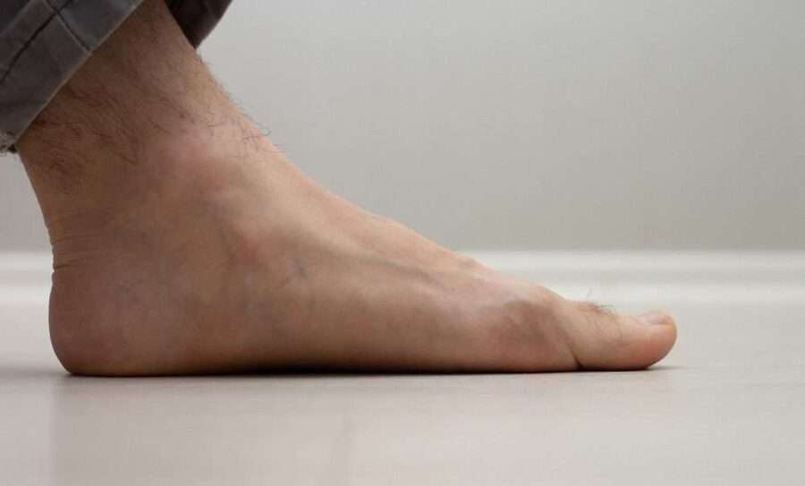 Image de :Flat feet: pains and treatments