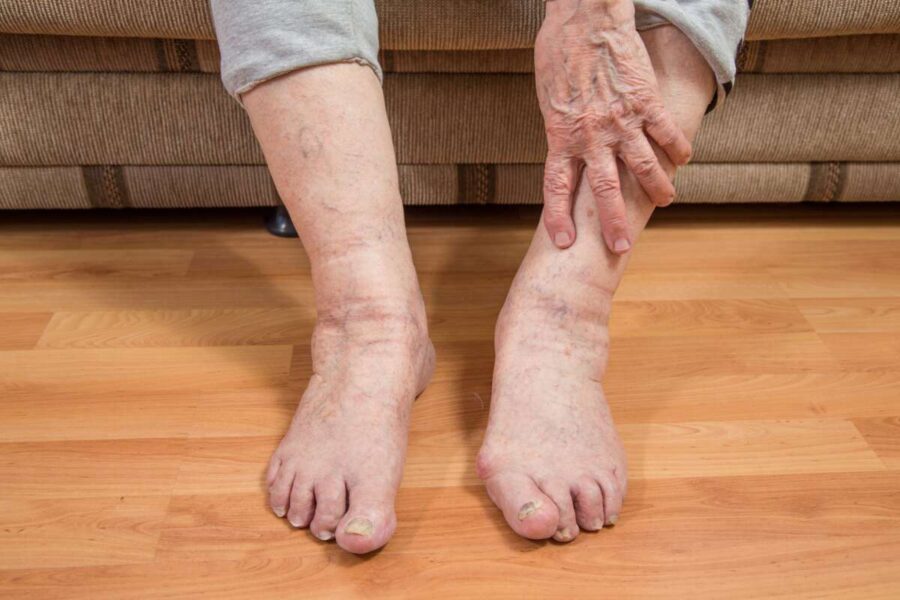 Image de :Les déformations du pied