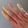 Raynaud’s disease : symptoms and treatments
