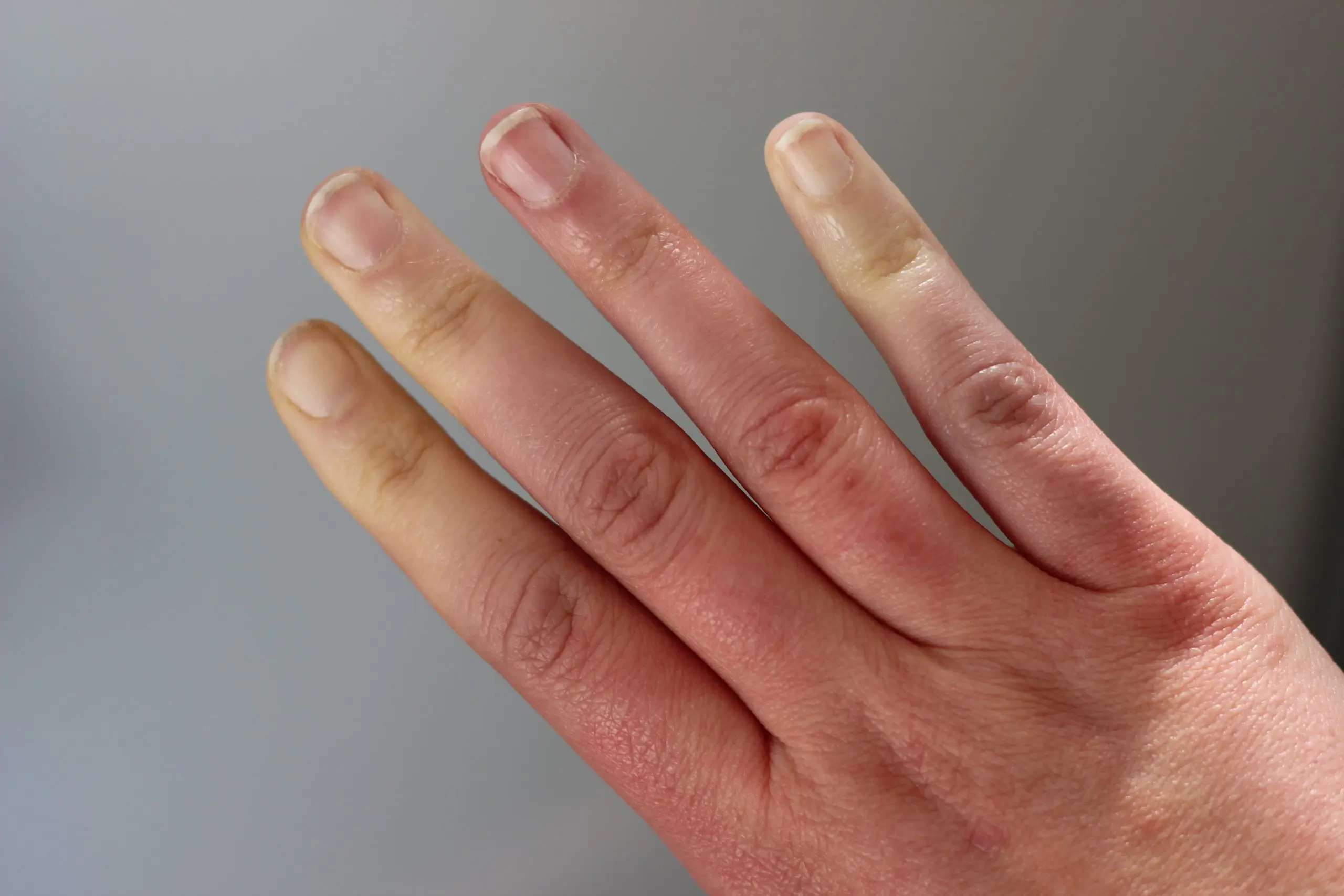 La maladie de Raynaud