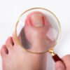 Toenail paronychia : symptoms and treatments