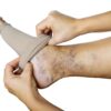Leg disorders caused by venous insufficiency