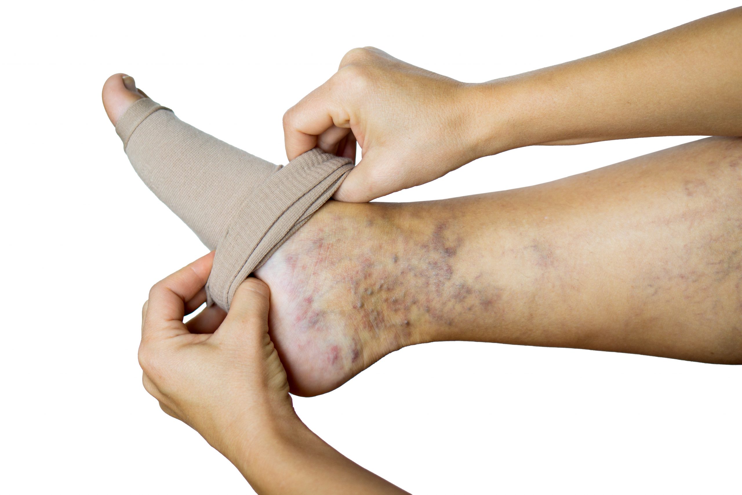 Leg disorders caused by venous insufficiency