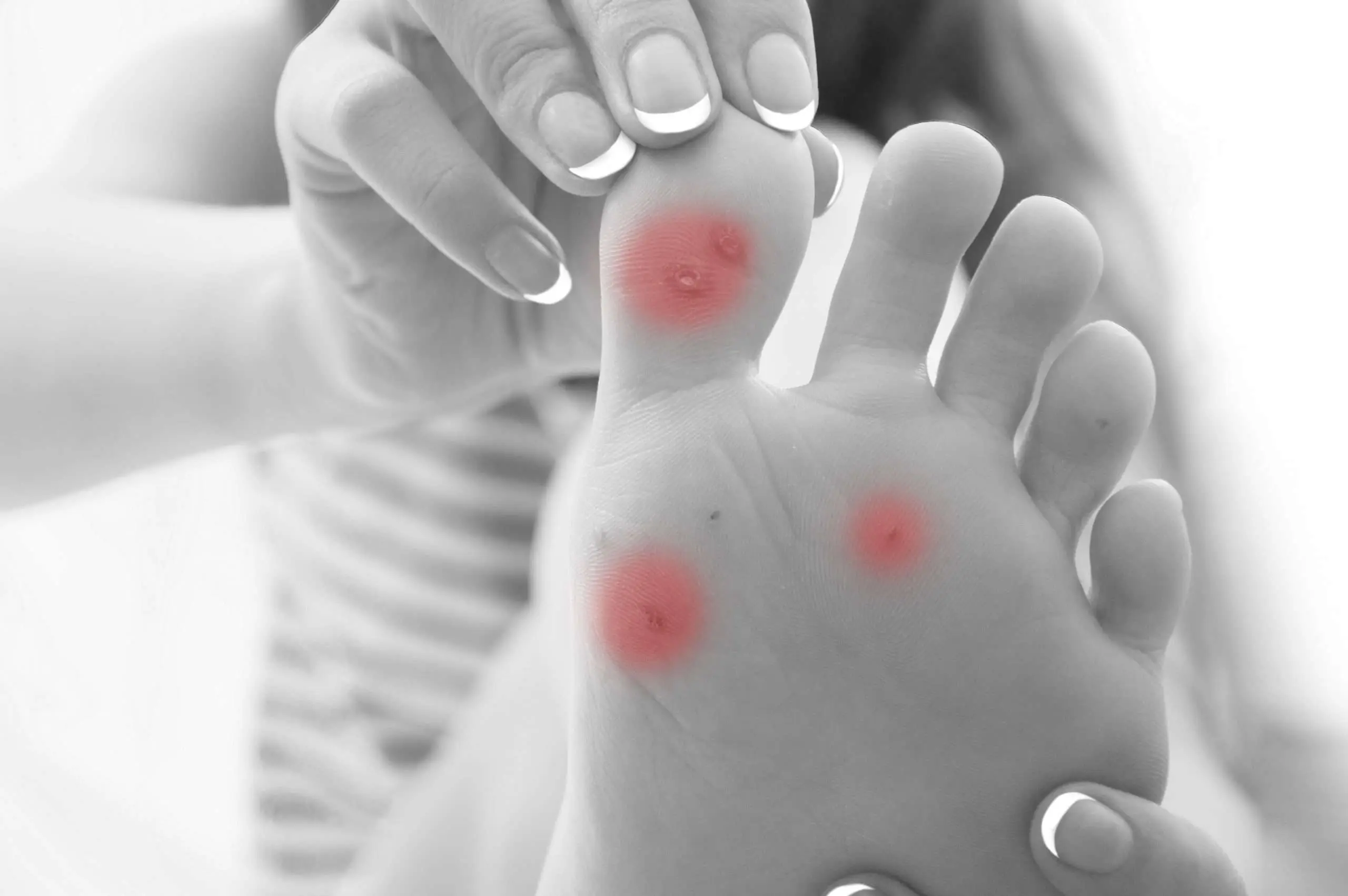 Distinguishing and treating common and plantar warts