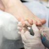 Toenail deformity : treatments