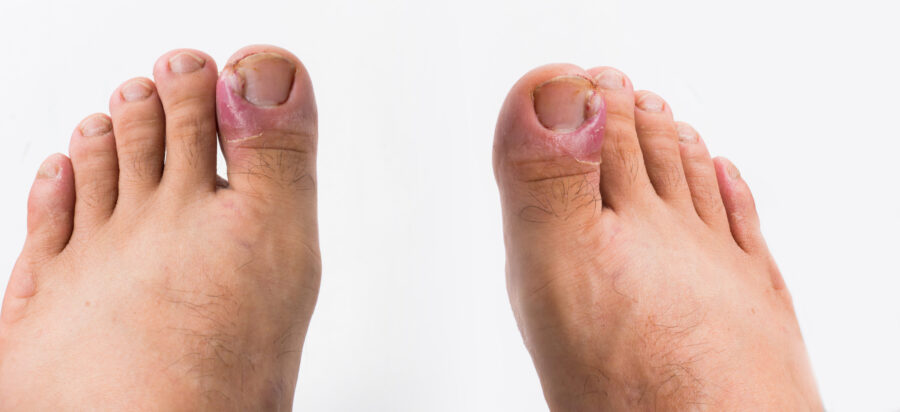 Image de :Treatments for paronychia of the toe