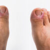 Treatments for paronychia of the toe