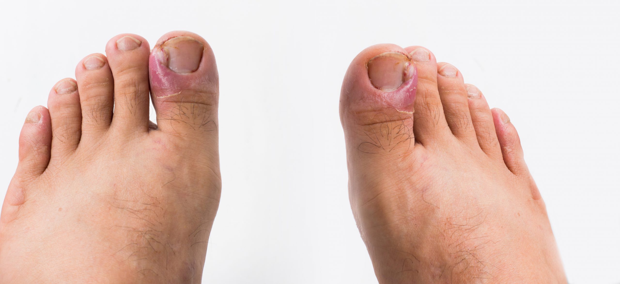 Treatments for paronychia of the toe