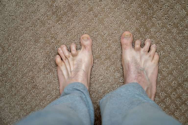 How to prevent or relieve hammertoes?