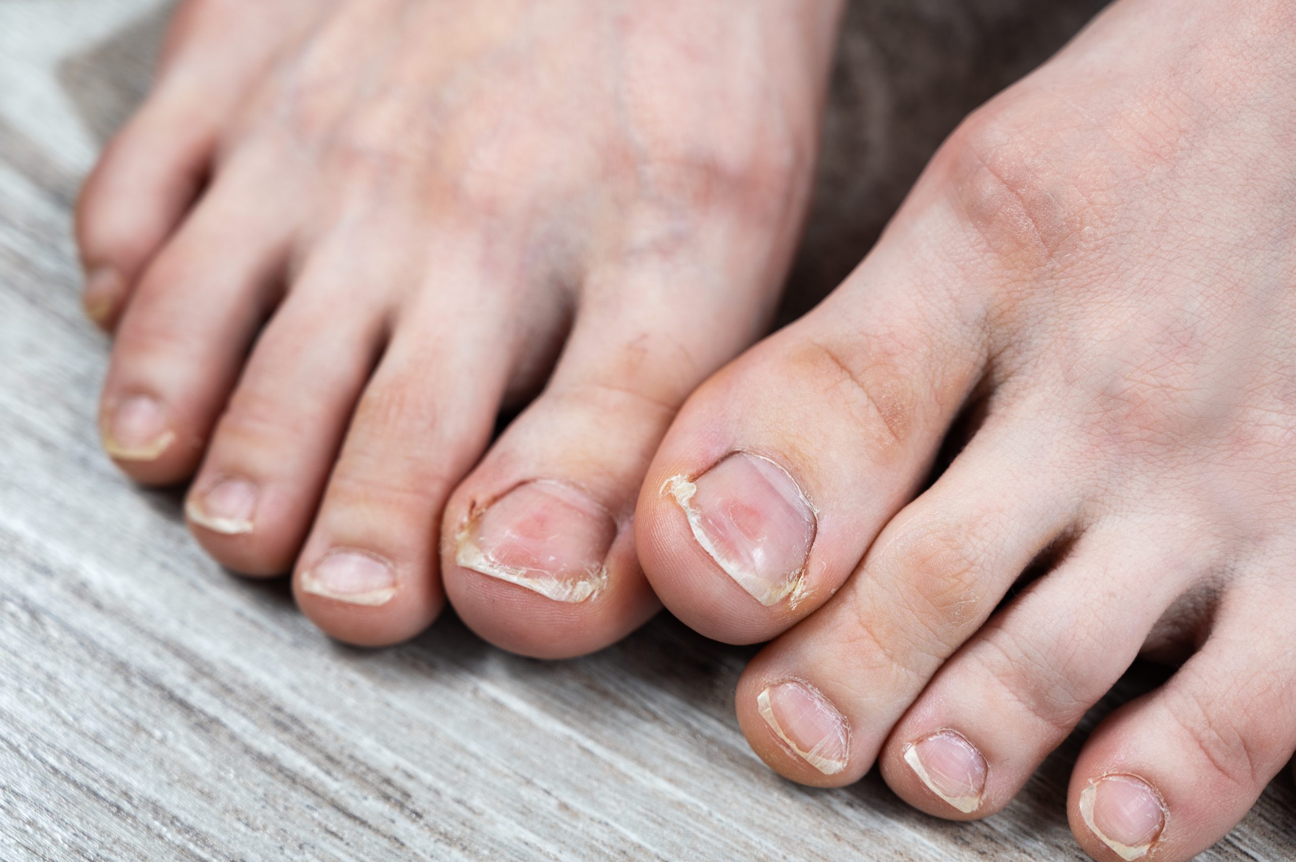 How to prevent and treat ingrown toenails?
