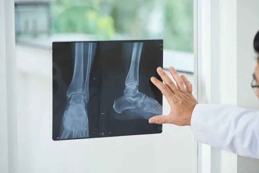 Image de :Qu’est-ce qu’une fracture de fatigue ou de stress au pied?