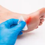 Pied diabétique : un podiatre pour le soigner