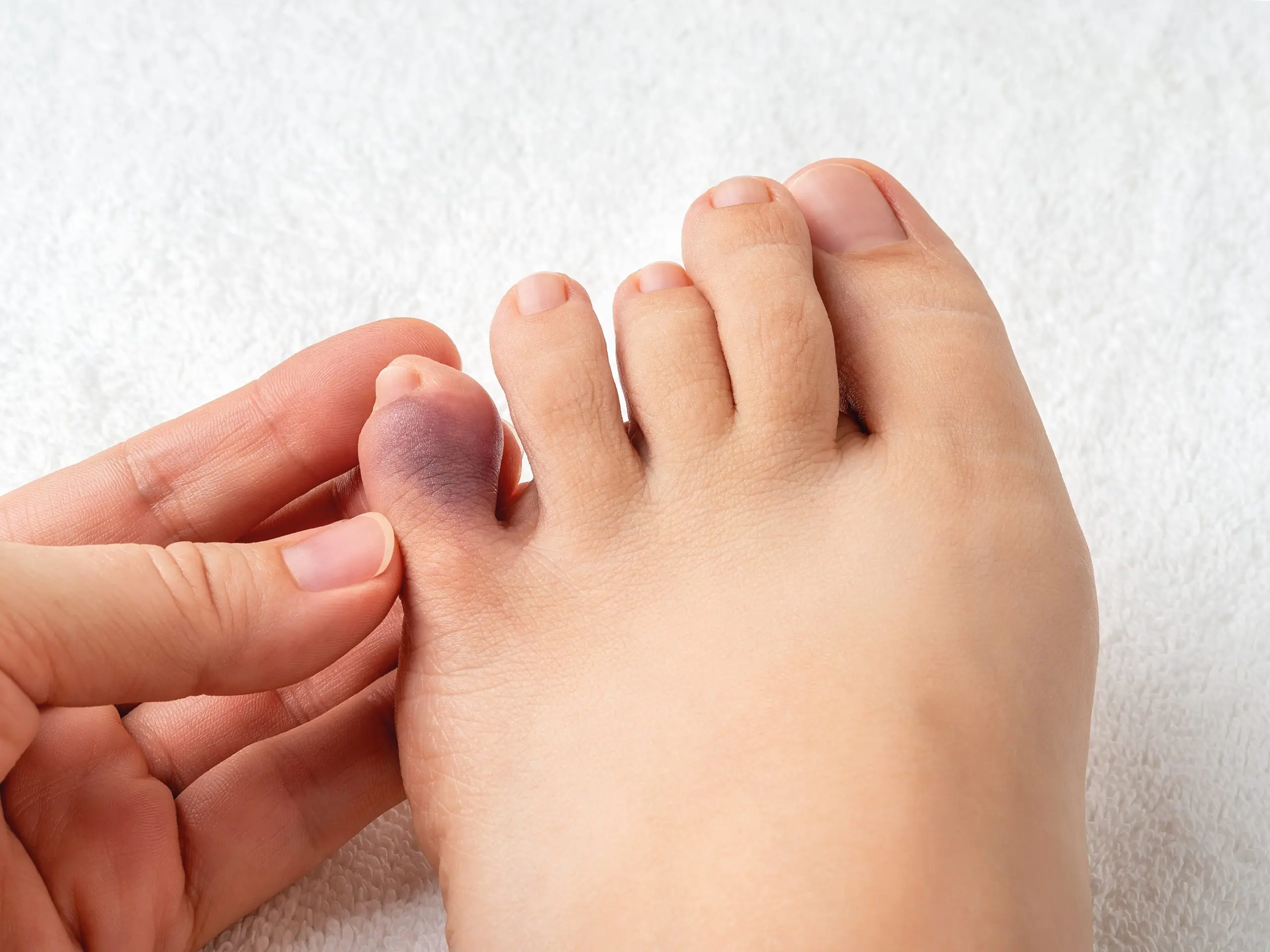 4 misconceptions about toe fracture