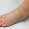Remedies for swollen feet