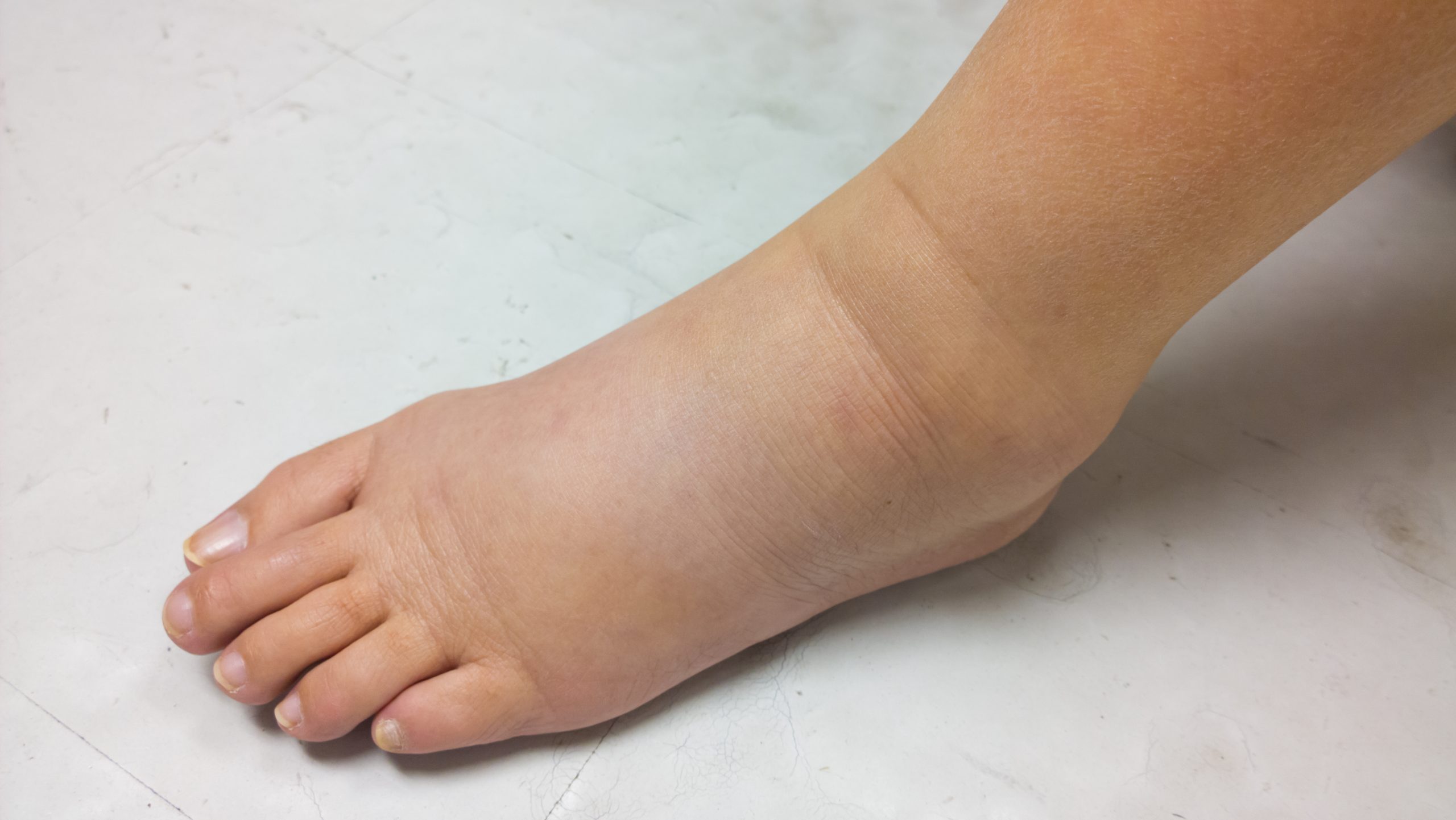 Santé des pieds : Conseils pour traiter le pied enflé - PiedRéseau