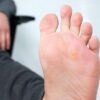 How to remove and avoid foot corns