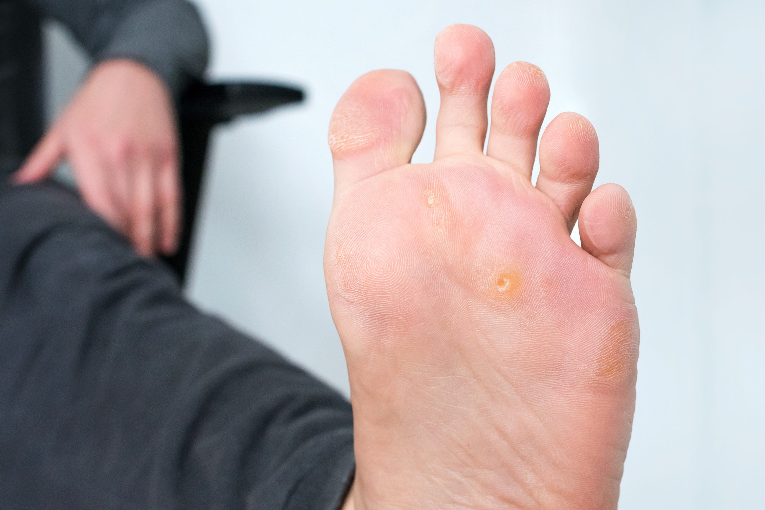 How to remove and avoid foot corns