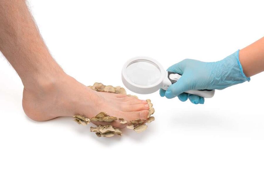 Image de :Les types de champignons qui peuvent affecter le pied