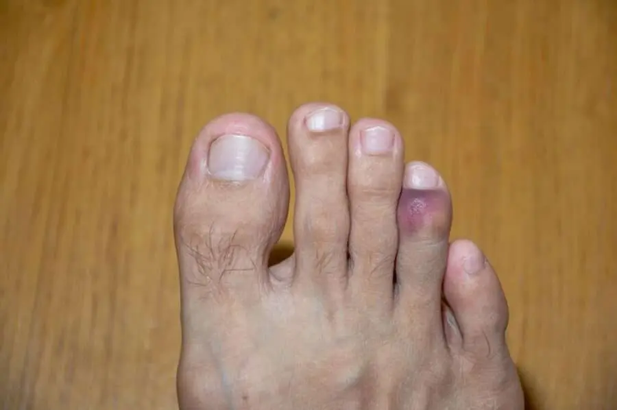 Toe Disintegration Distinguishing a sprain from a dislocation in the toes. - PiedRéseau
