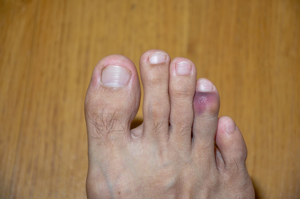 How to differentiate between a toe sprain and a toe dislocation?