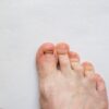 Torn Toenail: What to Do After Trauma?